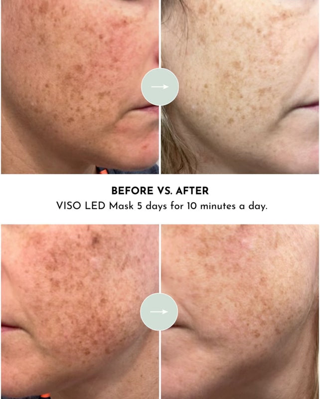 VISO - FDA 510(k) Cleared Red Light Therapy Mask